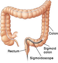 Illustration of a flexible sigmoidoscopy