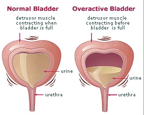 Diagrams of normal bladder and overactive bladder.