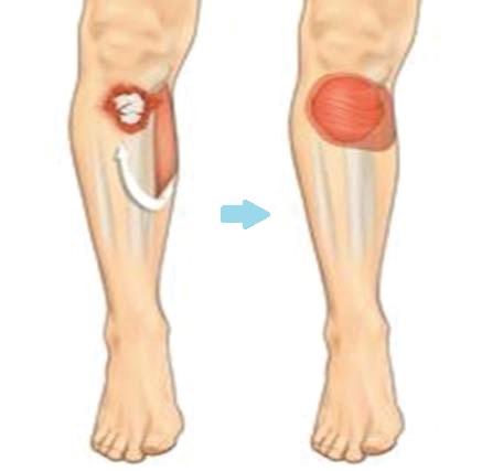 Calf muscle transferred to cover a wound at the front of the leg