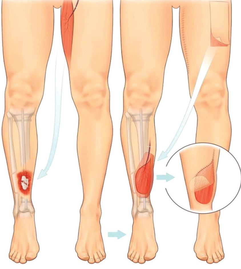Diagram depicts a muscle taken from the thigh to cover a wound over an open fracture on the other leg; the donor site is closed directly, and the muscle flap is covered with a skin graft