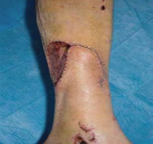 Skin and fat flap mobilised to cover wound on leg with secondary wound resurfaced with skin graft.