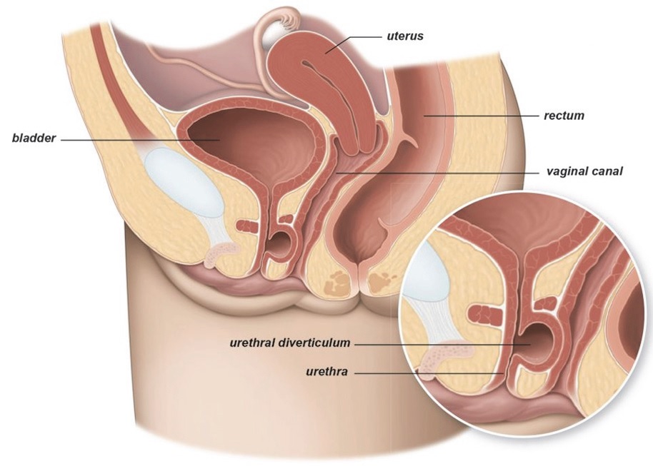 Excision of urethral diverticulum University Hospitals Sussex NHS Foundation Trust