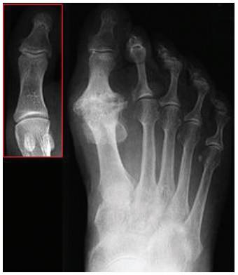 Hallux rigidus, before and after surgery