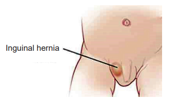 inguinal bubo vs inguinal hernia