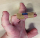 Image of a bent finger in a splint