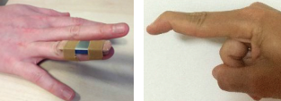 Images of a finger in a splint and a bent finger without the splint