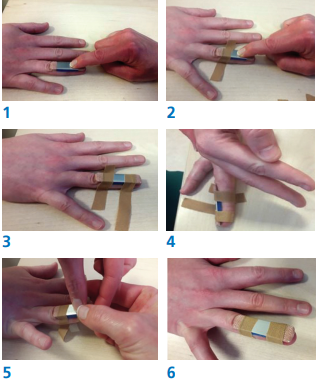 Images of the 6 steps required to replace a splint