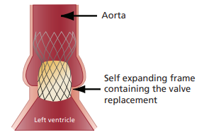 Diagram of aorta and self expanding frame containing the valve replacement