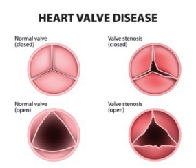 Diagram of normal and closed valve and stenosis
