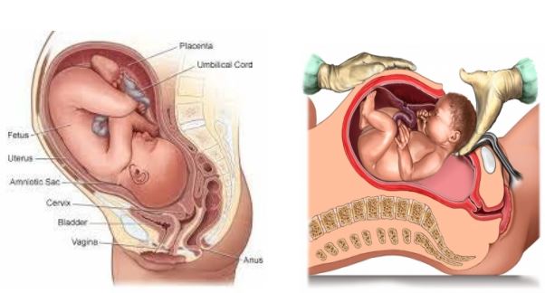  Elective caesarian section