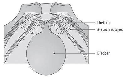 Diagram of Burch Colposuspension
