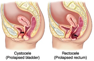 Prolapsed bladder and prolapsed rectum
