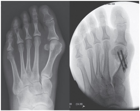 Hallux valgus before and after surgery