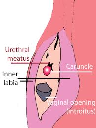 Urethral Caruncle