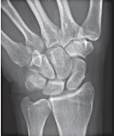 Normal wrist X-ray