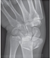 Broken distal radius