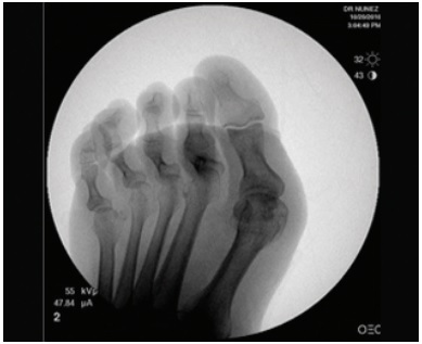 Hammer and mallet toe x-ray before operation