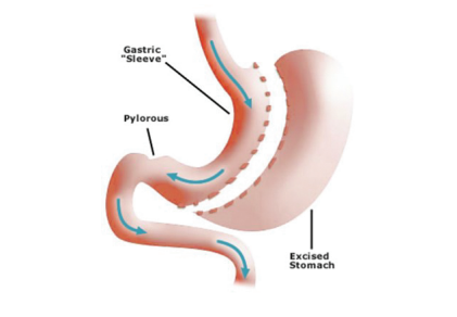 Diagram of the gastric sleeve, pylorous and excised stomach