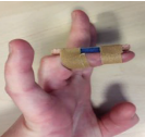 Mallet finger - NHS