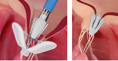 Images of the PASCAL procedure