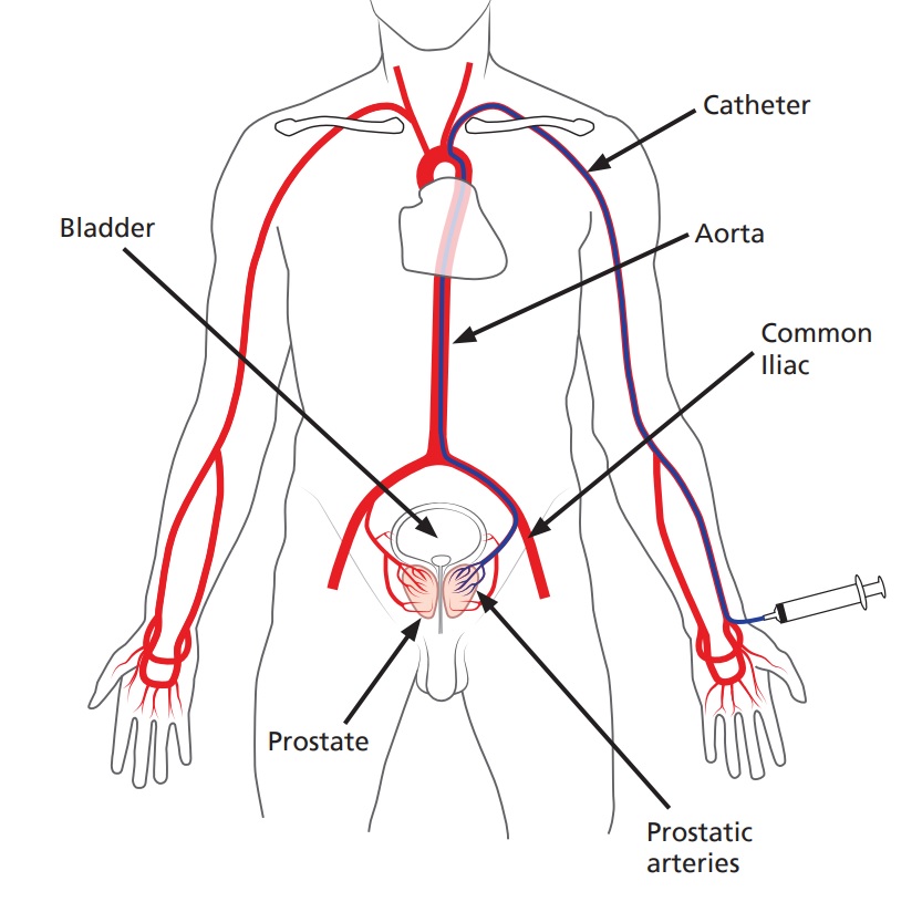 Access via arteries in wrist