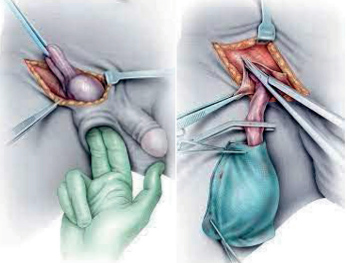 Images of the Radical Orchidectomy operation