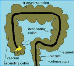 Colonoscopy examination illustration