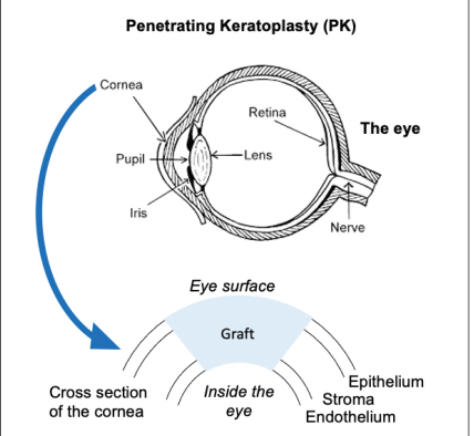Diagram of Penetrating Keratoplasty