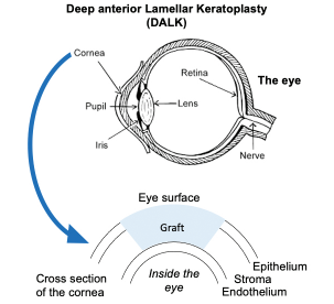 Diagram of deep anterior Lamellar Keratoplasty