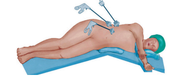 Drawing of a person being operated on