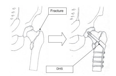 Fracture and dynamic hip screw