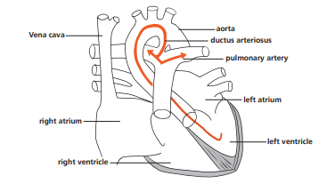 Heart with patent ductus arteriosus
