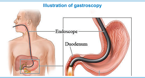 Illustration of gastroscopy