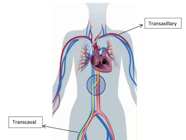 The body showing the transaxillary and transcaval