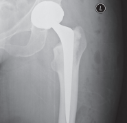 X ray of hip joint