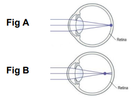 Myopia