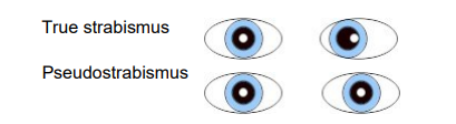 Images of true strabismus and pseudostrabismus