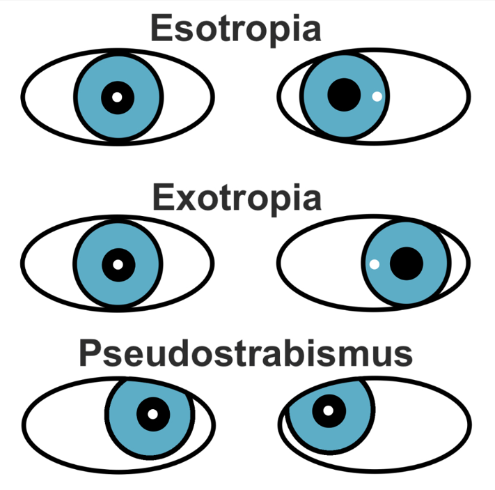 Images pseudoesotropia/exotropia.