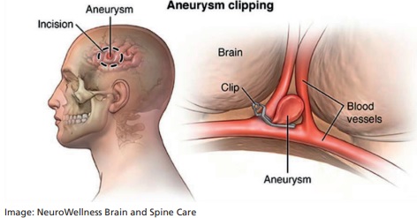 Aneurysm clipping