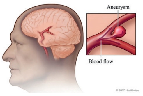 Blood flow during an aneurysm
