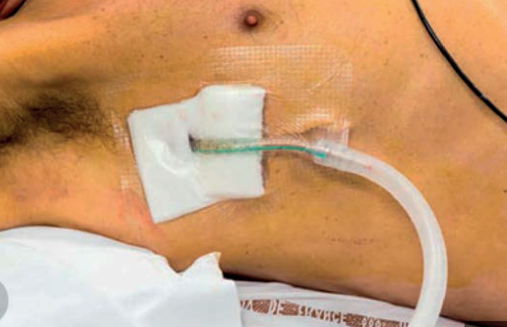 Traumatic chest drain insertion site
