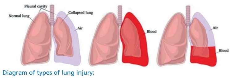 Types of lung injury