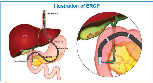 Illustration of ERCP