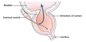 Retrograde ejaculation diagram