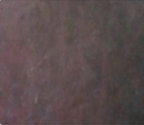 Stage one pressure ulcer on black skin