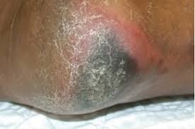 Stage two pressure ulcer on black skin