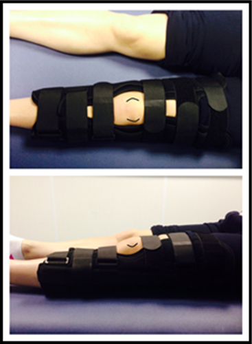 Fitting a splint
