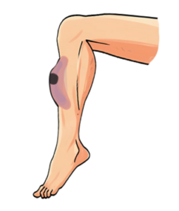 Managing a haematoma on your leg with dressings (conservative ...