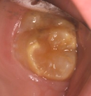 Image of teeth with enamel defects.