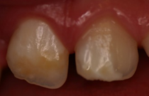 Image of teeth with enamel defects.